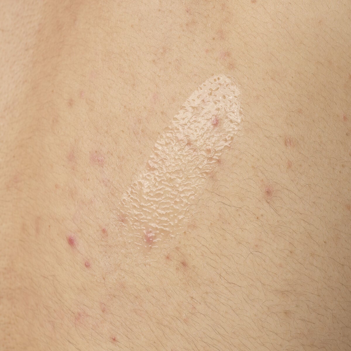salicylic-acid-0-5-body-serum-t1 ORD-salicylic-acid-05-body-240ml-application.jpg