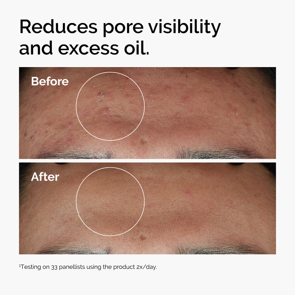 niacinamide-10-zinc-1-x8 ord-niacinamide-zinc-blemish-serum-before-after-pores.jpg