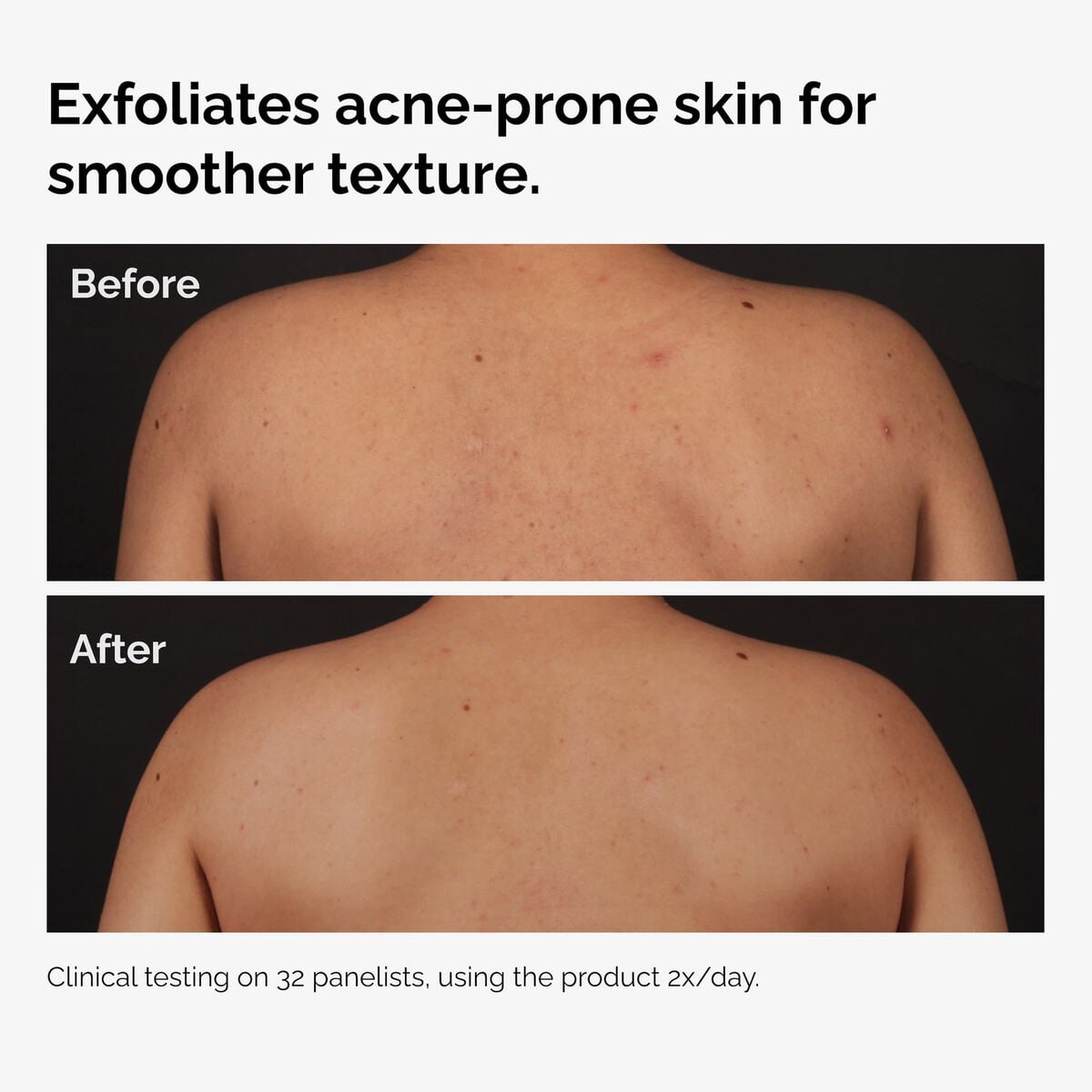 salicylic-acid-0-5-body-serum-t1 ord-salicylic-acid-body-serum-before-after-graphic-NA.jpg